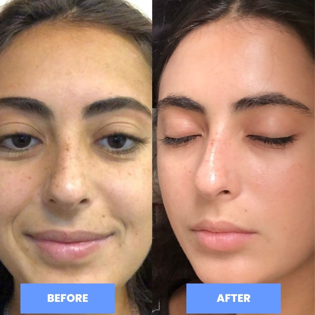 Before and after skincare results after using the glow up bundle